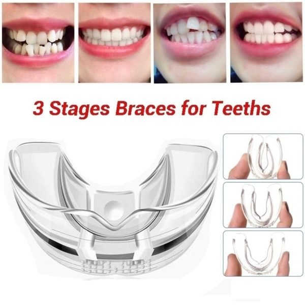 Teeth Straightening braces